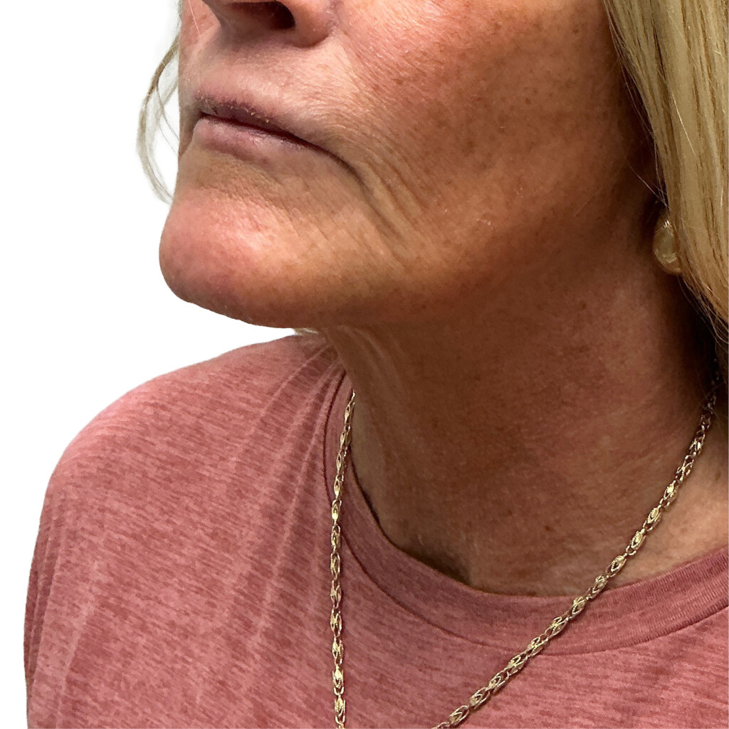 After Ultherapy treatment showing the lower face, jawline and neck from a front angle