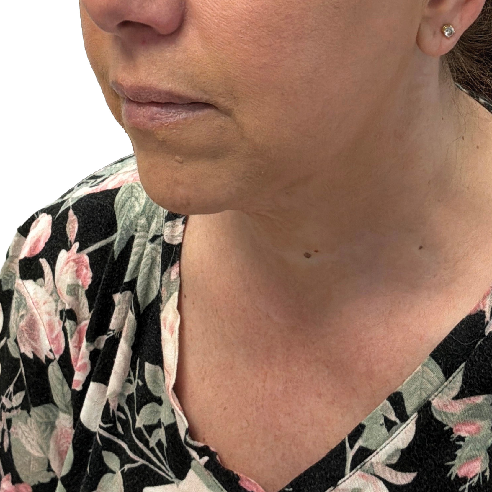 After Ultherapy treatment showing the lower face, jawline and upper neck from the front