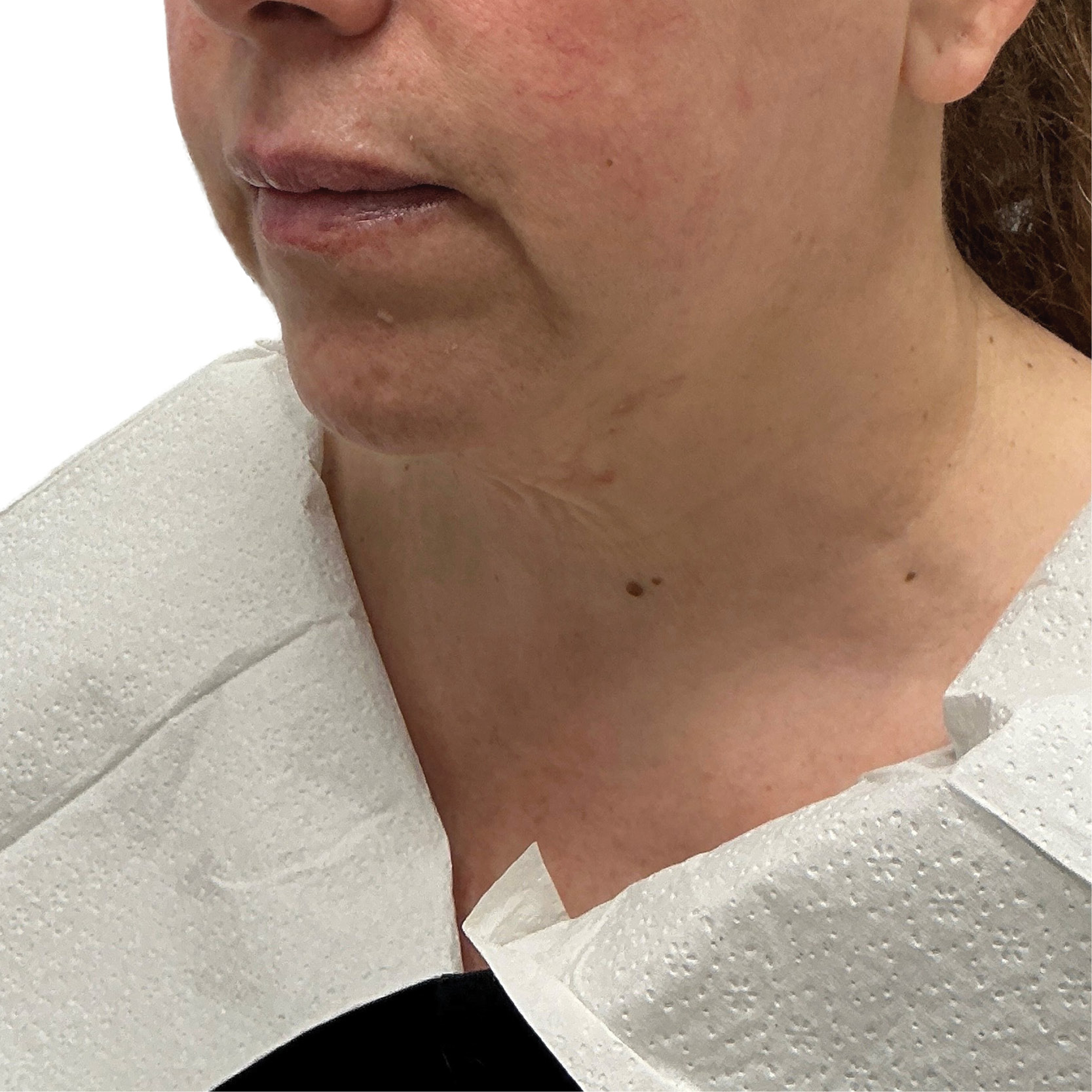 Before Ultherapy treatment showing the lower face, jawline and upper neck from the front