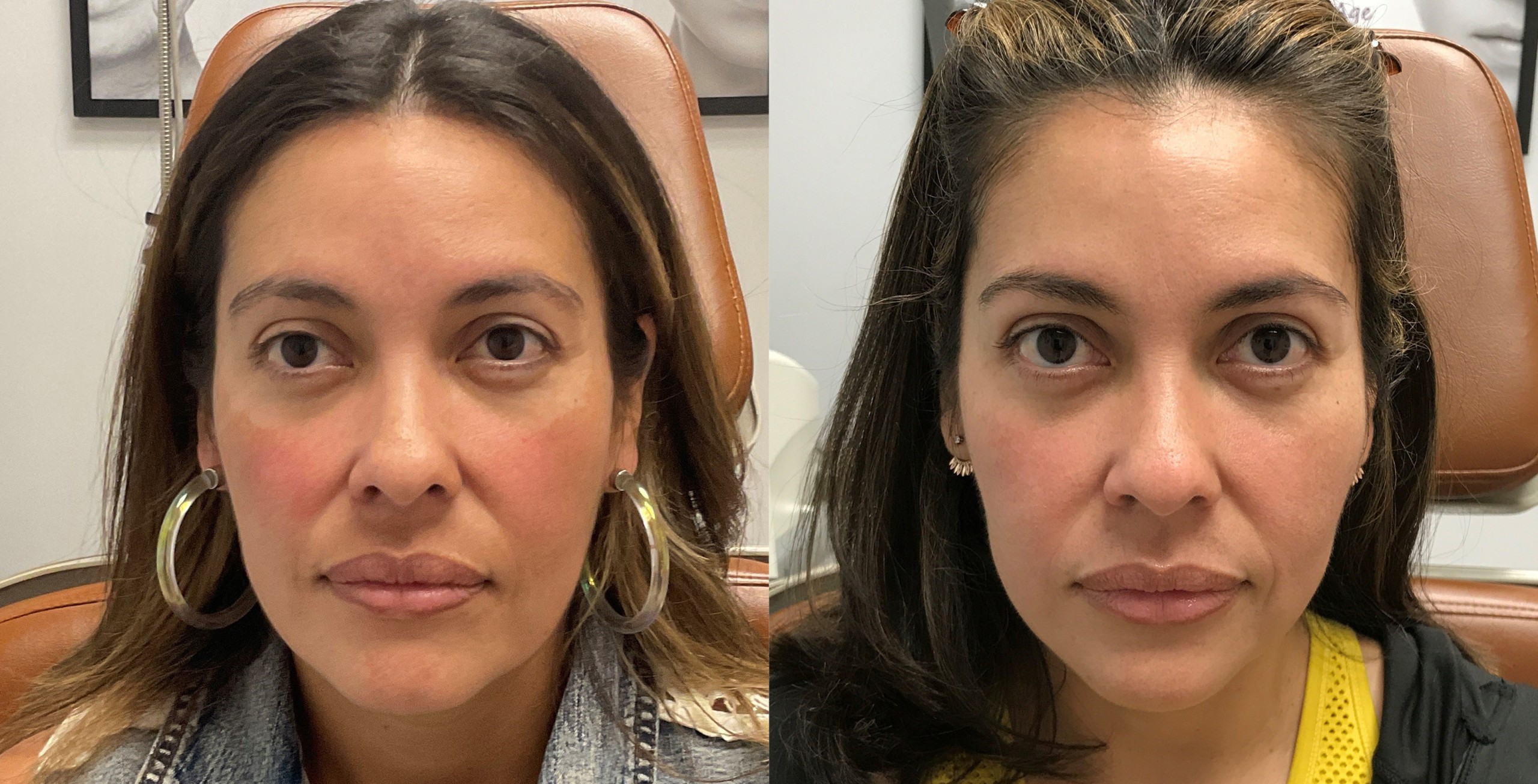 ultherapy before and after full face