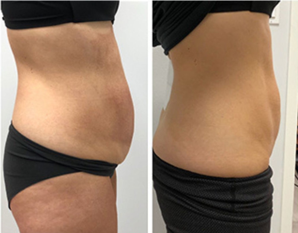 ultrashape before and after of a non-invasive cosmetic procedure