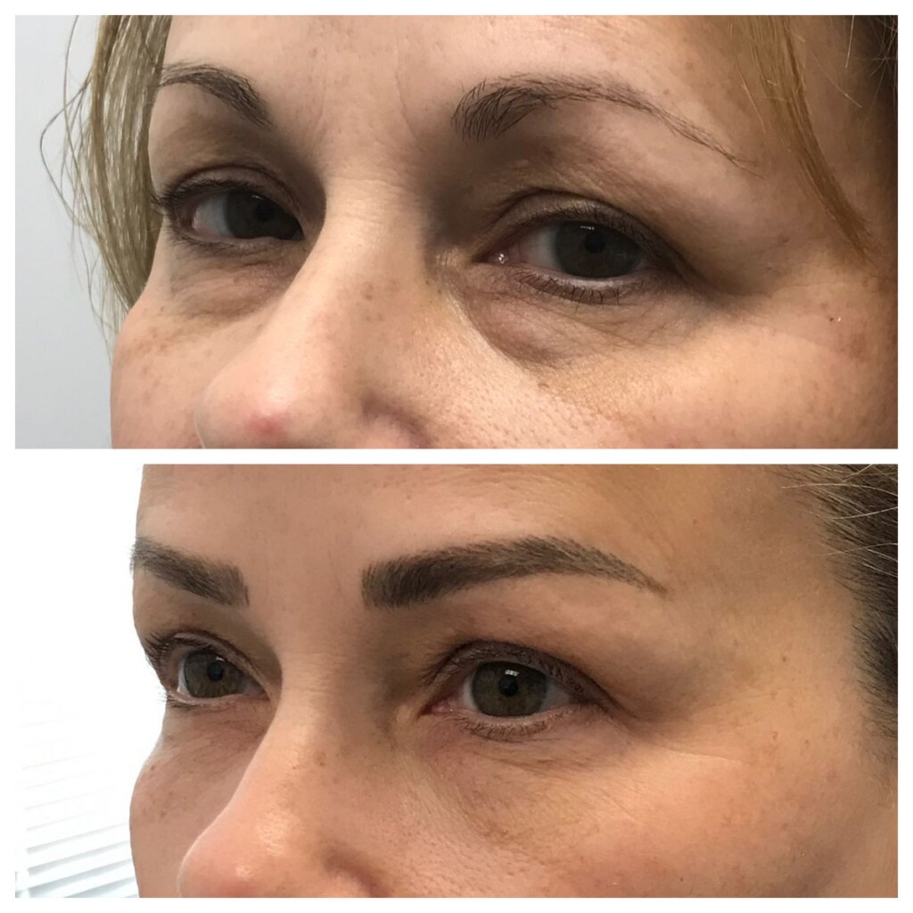 Side-by-side before-and-after close-up of a woman’s under-eye area showing a smoother, more supported appearance beneath the eyes after treatment.